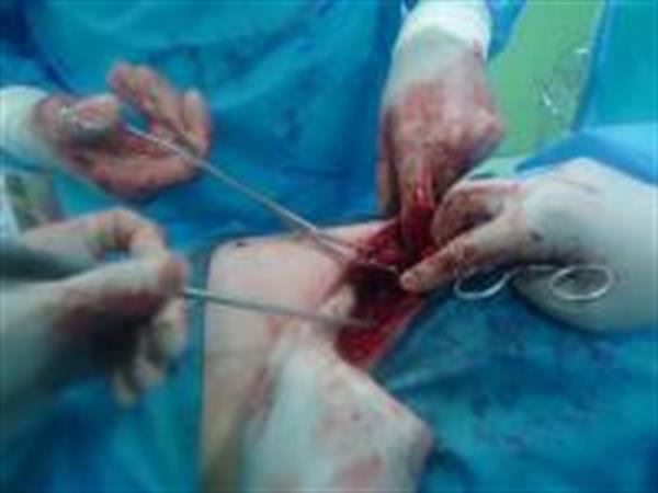 موفقیت در عمل جراحی  آنافروتیک نفرولیتوتومی ( سنگ کلیه شاخ گوزنی )